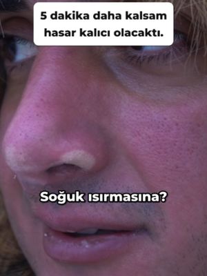 Oymyakon'da 15 dakikadan biraz fazla dışarıda kaldım ve burnum beyaza dönüp dokuları ölmeye başladı. Soğuk ısırması mı diye soruyordum. Öyleymiş. Yevdokia bunu hemen fark etti ve yüzümü kapatmamı söyledi. İşin bilimi …